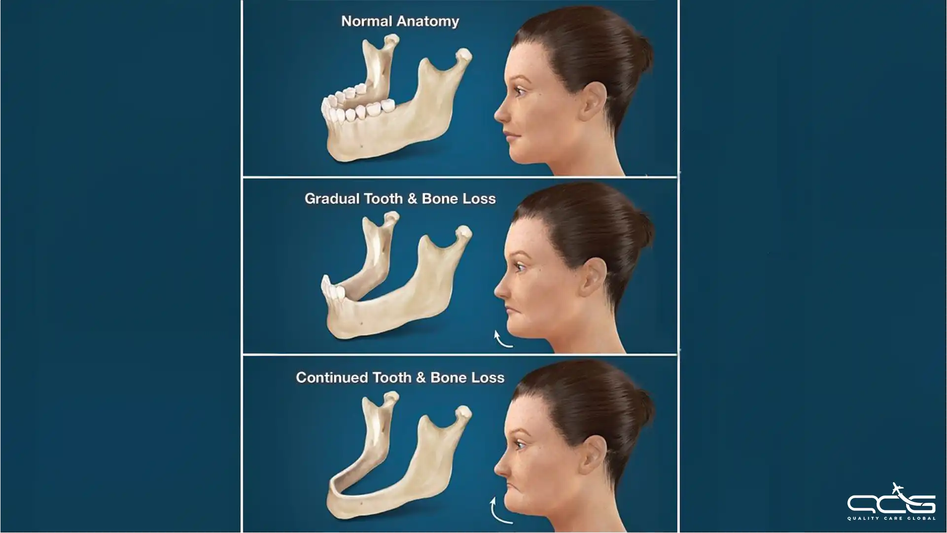 Bone Loss QCG.webp