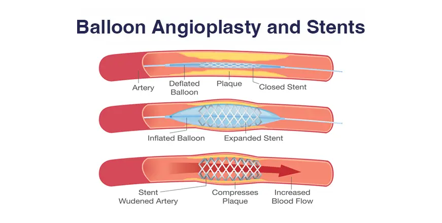 Cardiology_Content_CoronaryAngioplasty.webp