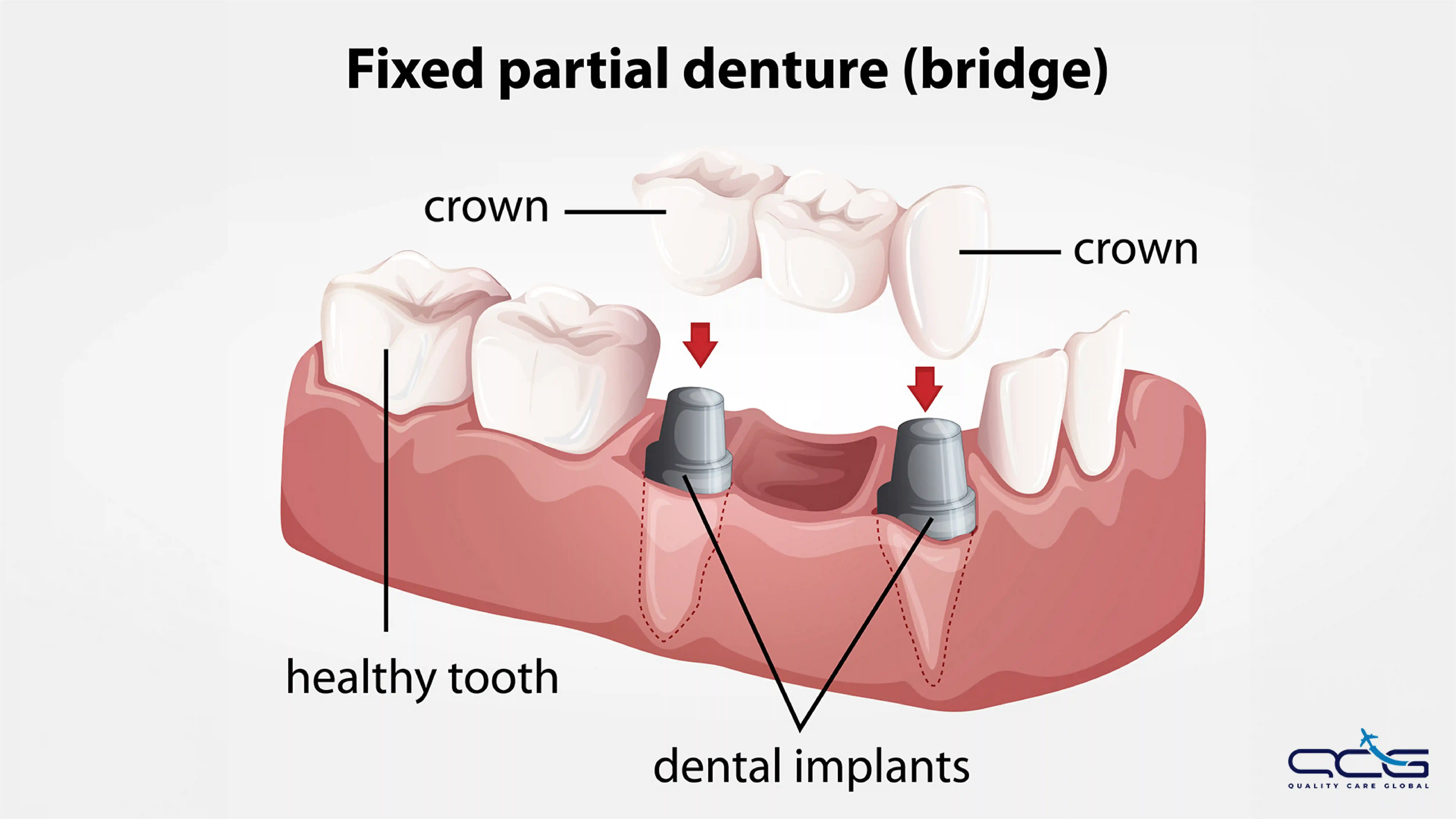 Dental Bridges vs. Implants1.webp