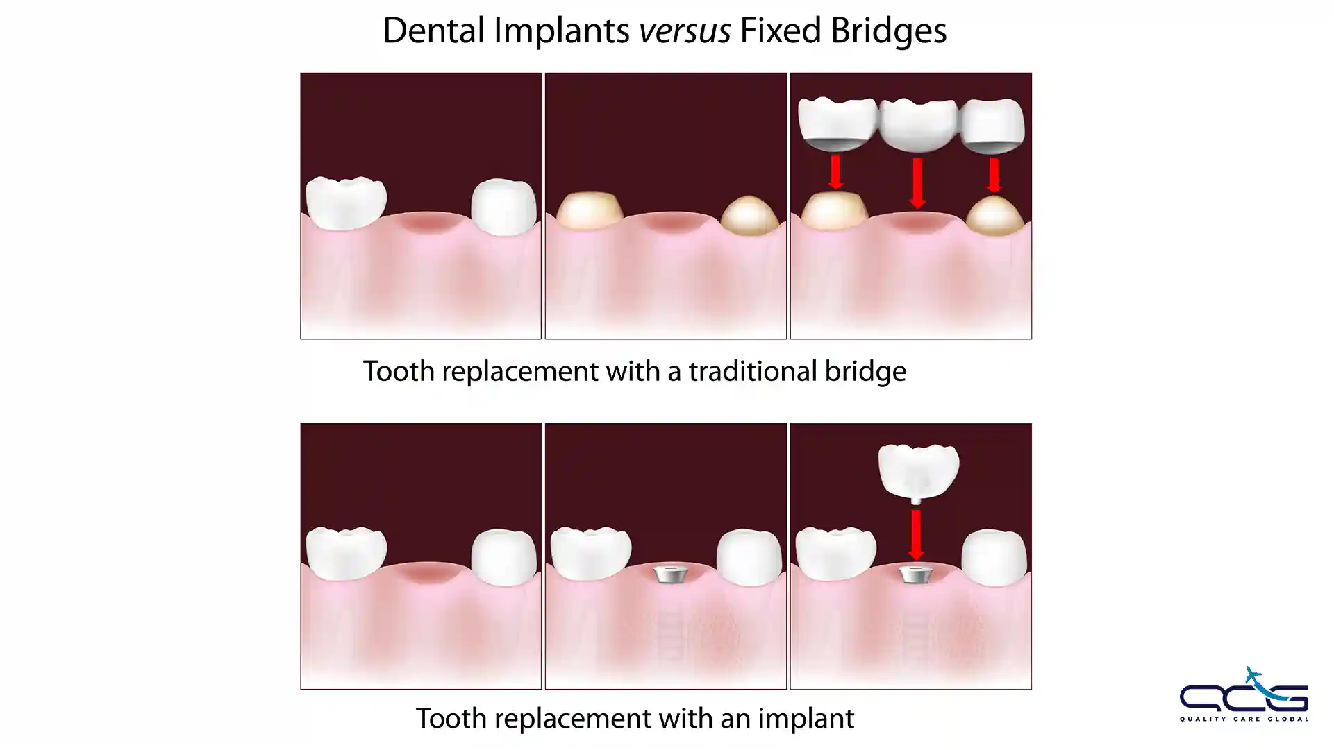 Dental Bridges vs. Implants.webp