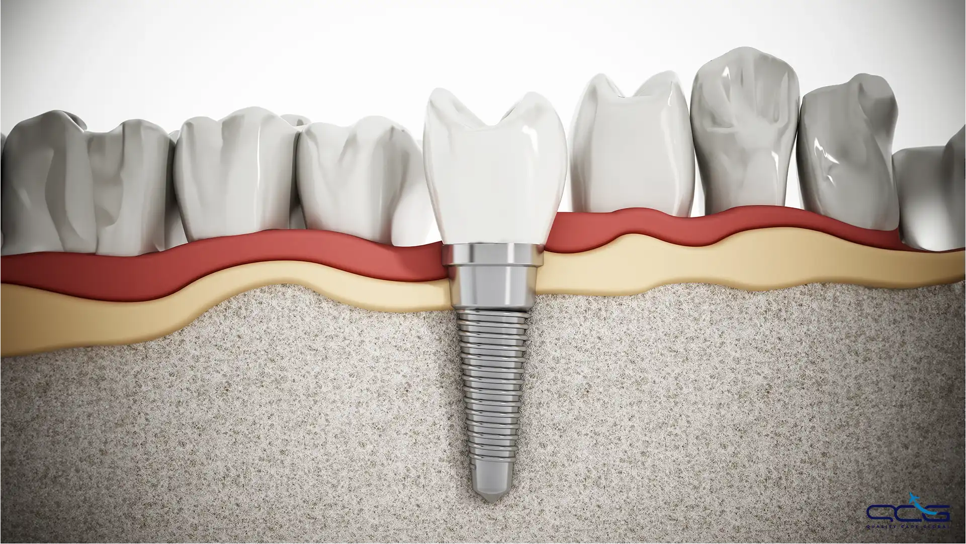 Dental Implant.webp