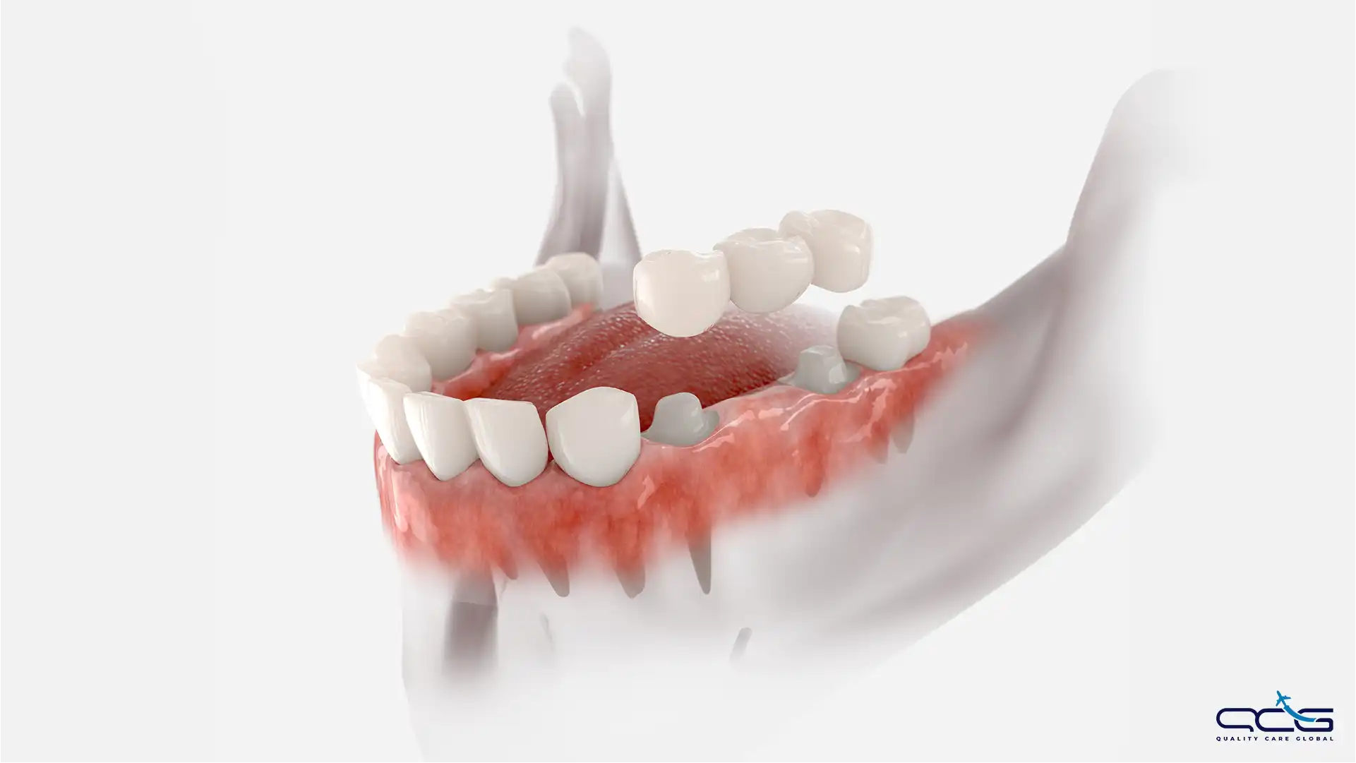 Fixed Dental Bridge.webp