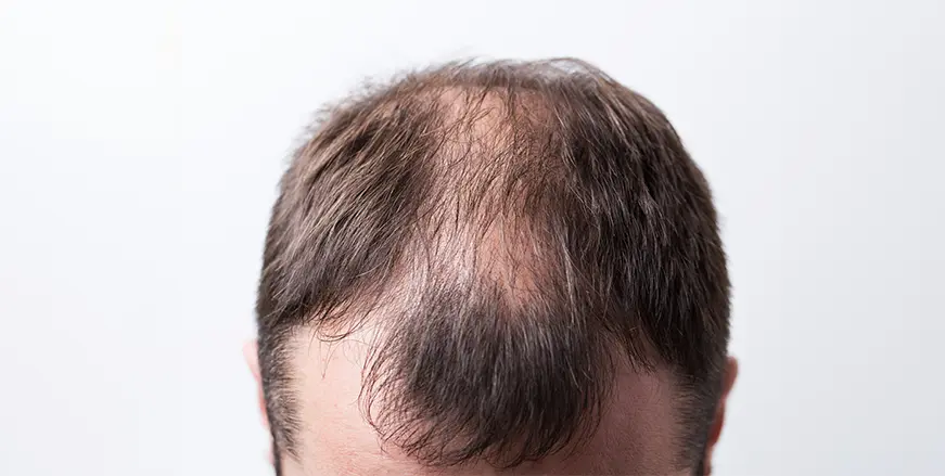 Plastic_Content_Hairtransplant3.webp