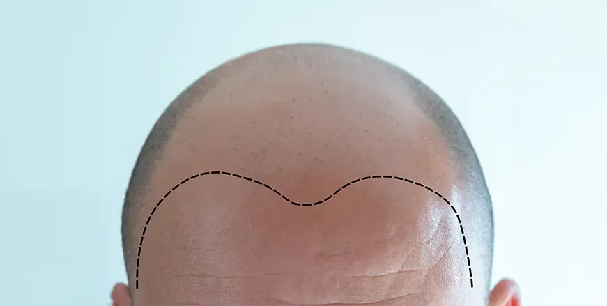 Plastic_Content_Hairtransplant4.webp