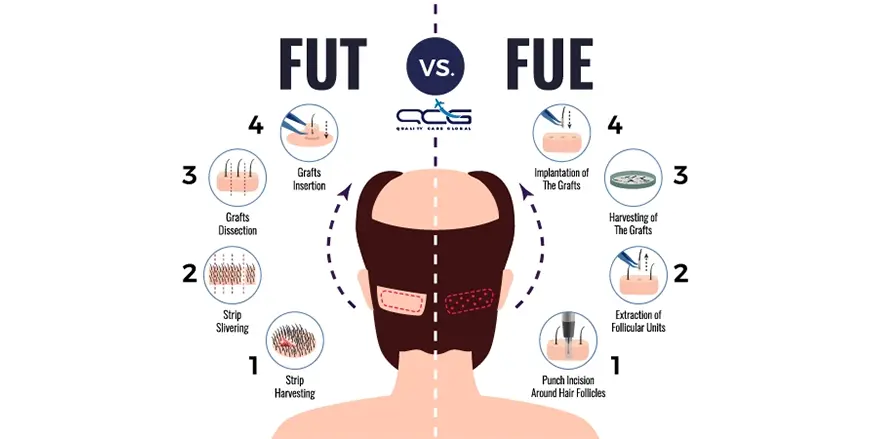 Plastic_Content_Hairtransplant.webp