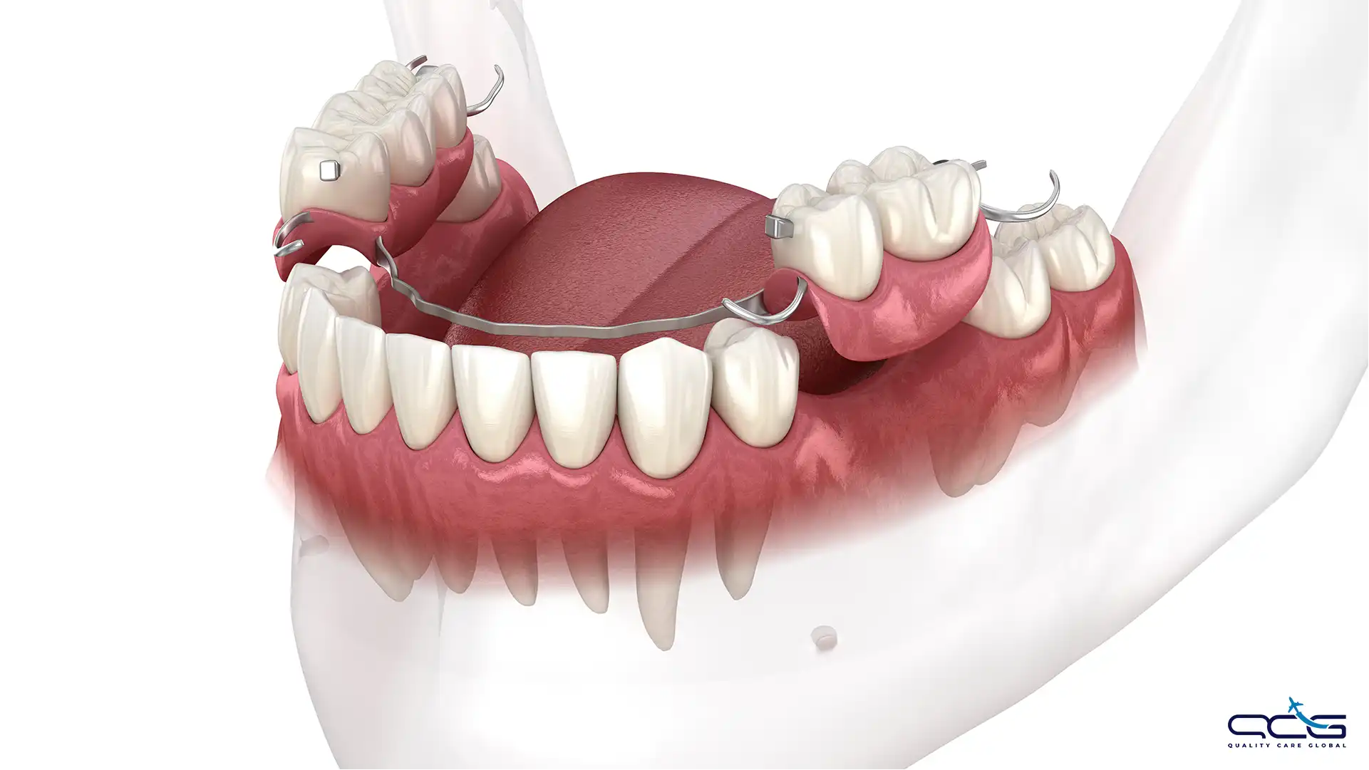 Removable Partial Dentures.webp