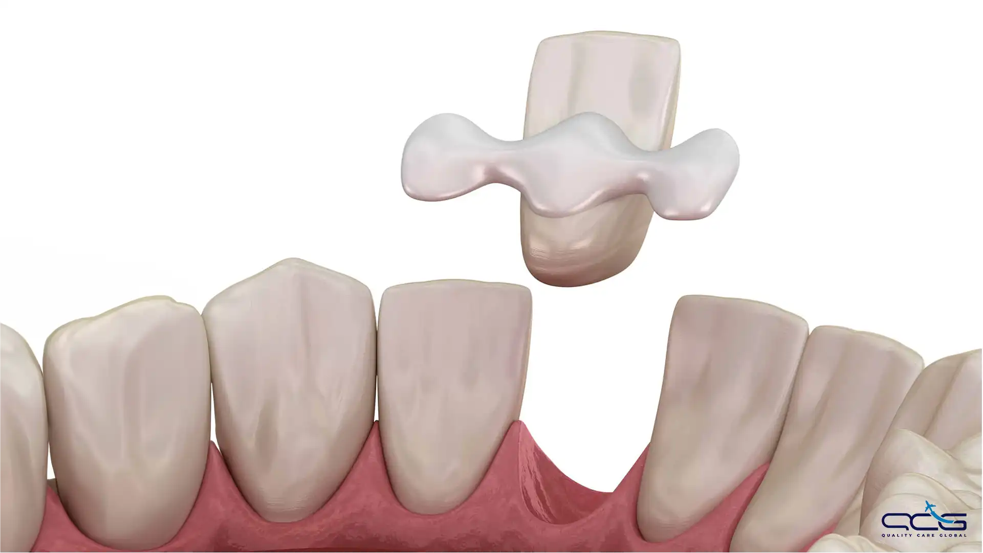 Resin-Bonded Bridge.webp