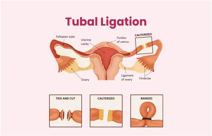 Tubal-Ligation.webp