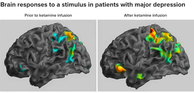 improved neural activity after ketamine treatment