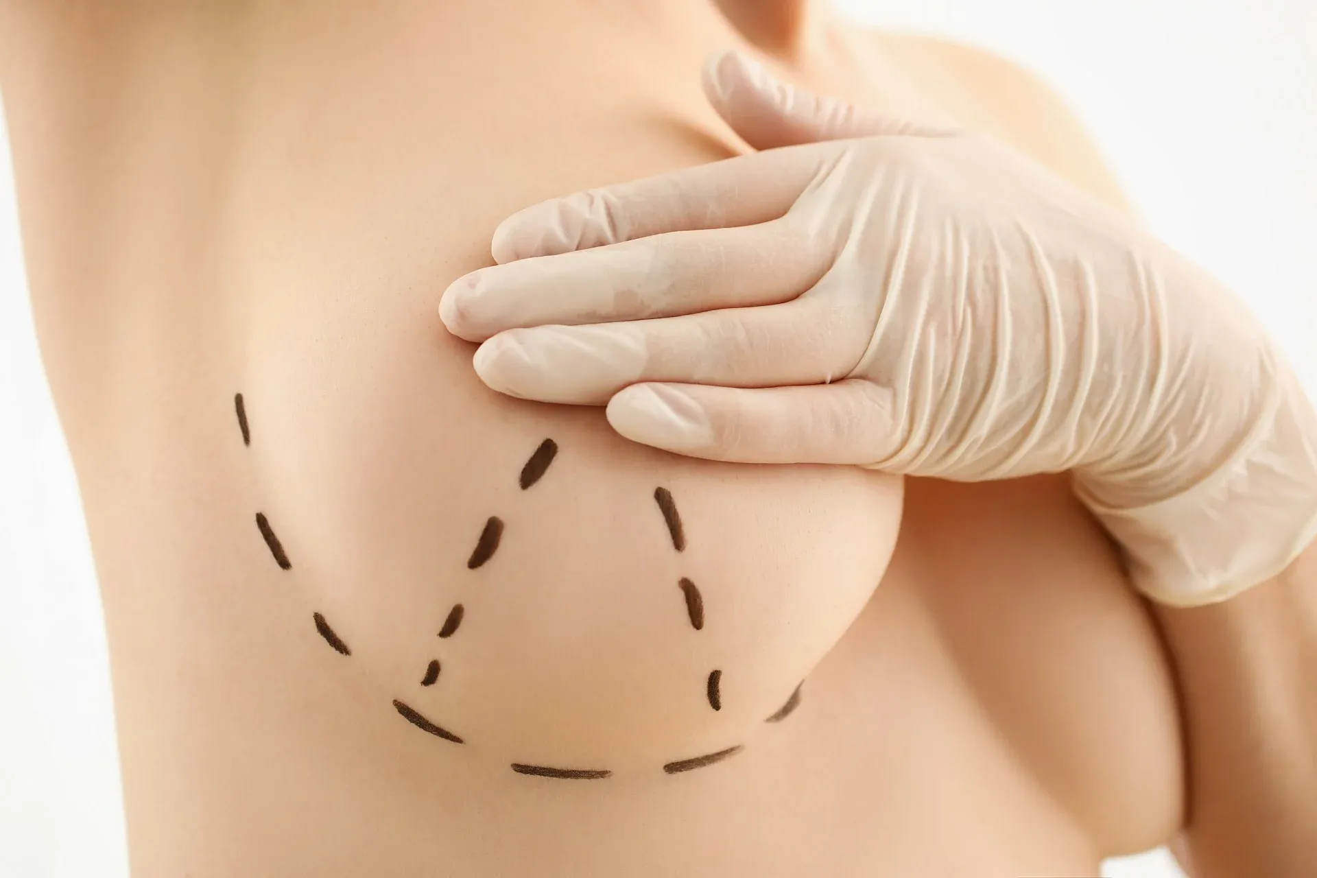 what to expect when you get a breast lift in mexico