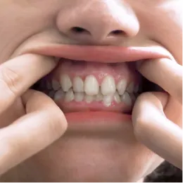 Front View – Lips Retracted