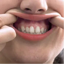 Upper Teeth