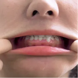 Lower Teeth