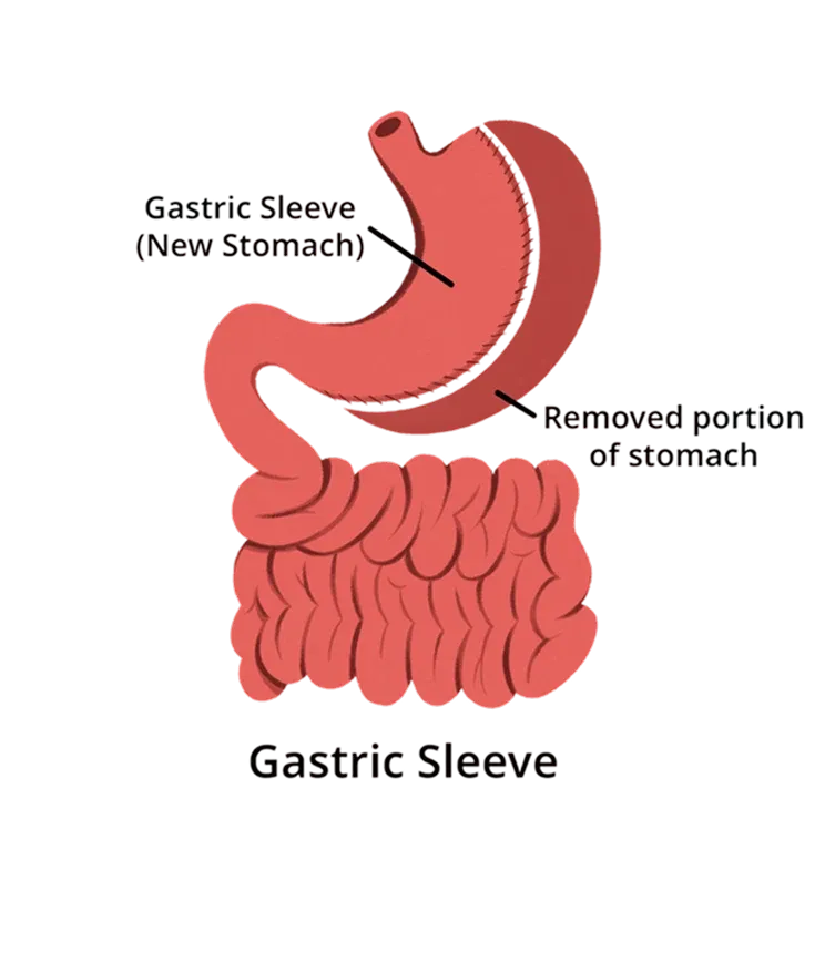 sleeve gastrectomy procedure for weight loss surgery