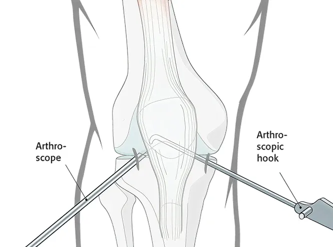a meniscus surgery being performed using arthroscopy