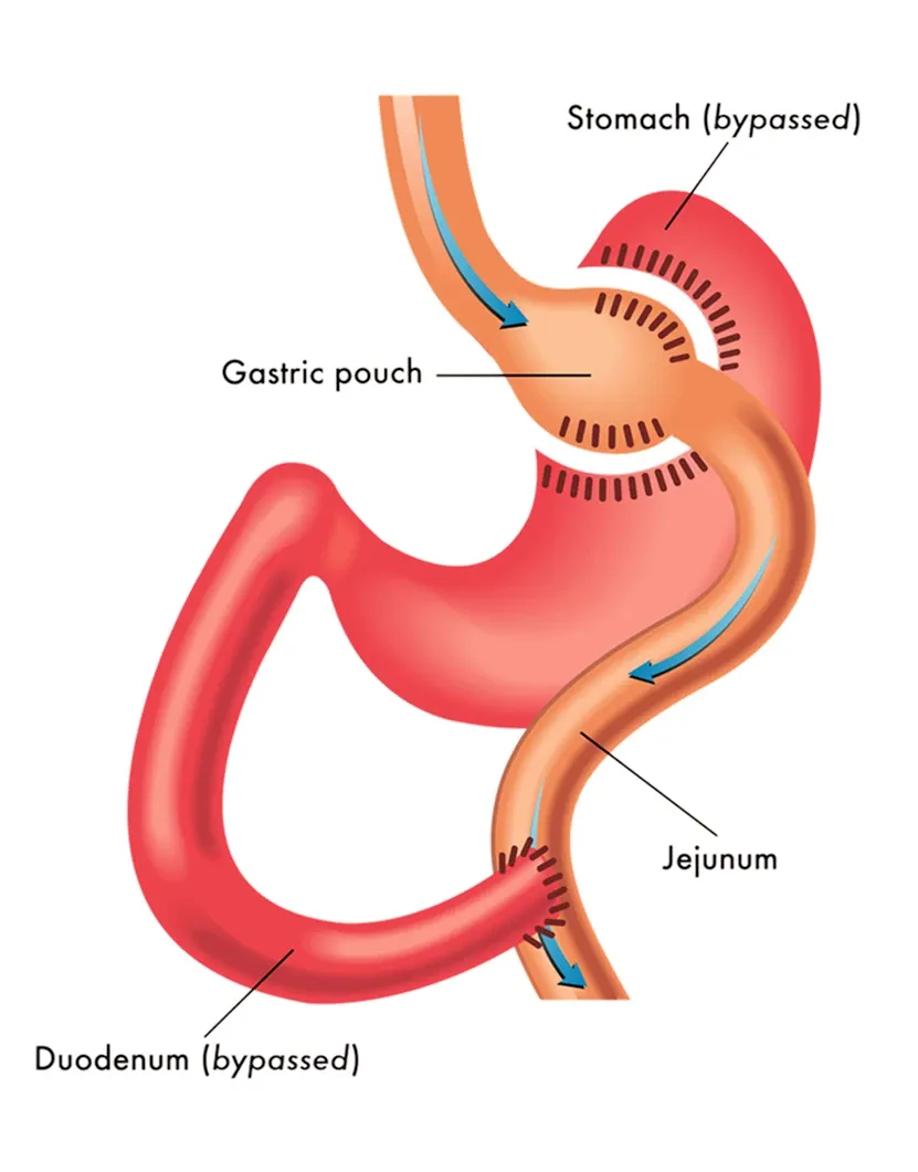 mini gastric bypass procedure for weight loss surgery