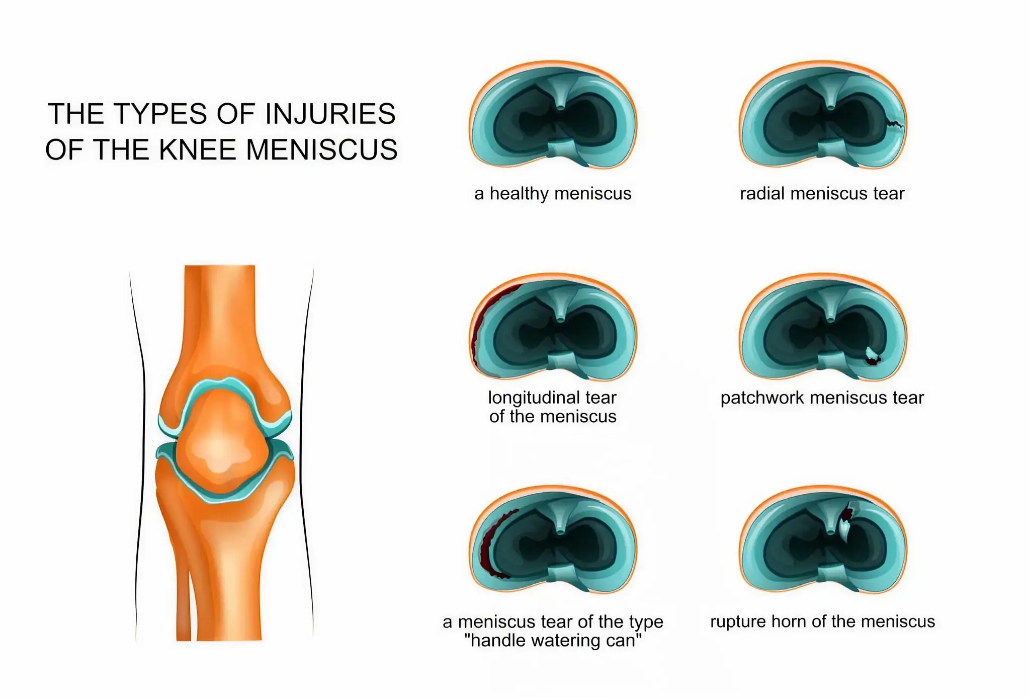 illustration showing different types of meniscus tears